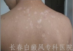 白癜风有什么症状